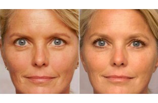 How anti-wrinkle creams work